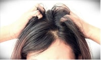 Removing dandruff and itchy scalp